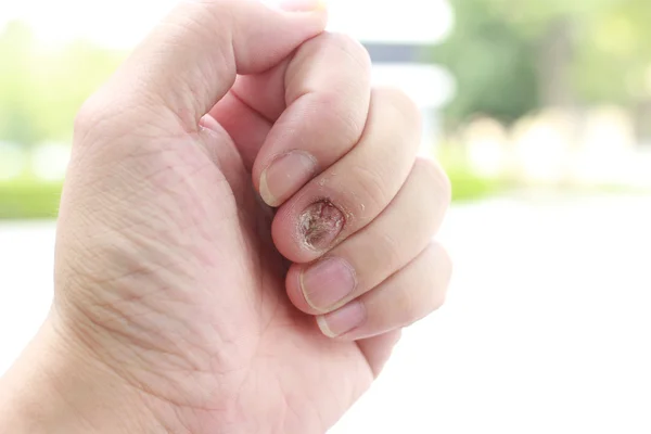 Грибкова інфекція нігтів і пошкодження рук людини. Палець з оніхомікозом — стокове фото