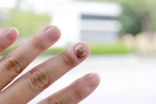 Fungal nail infection and damage on human hand. Finger with onychomycosis — Stock Photo, Image