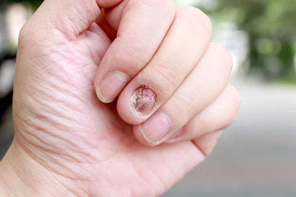 Svampinfektion spik infektion och skador på mänsklig hand. Finger med Onykomykos — Stockfoto
