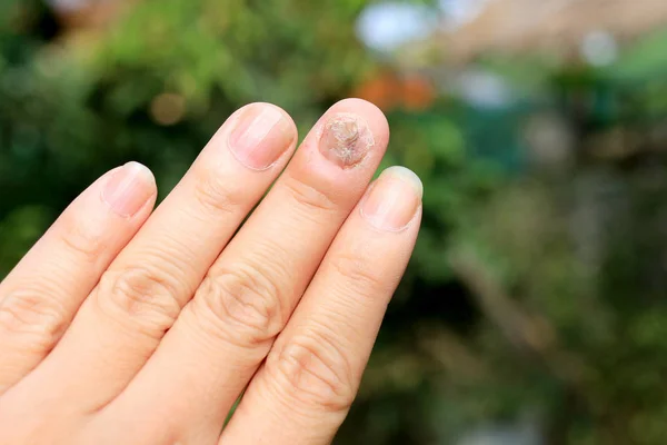 Fungus Infection on Nails Hand, Finger with onychomycosis — Stock Photo, Image