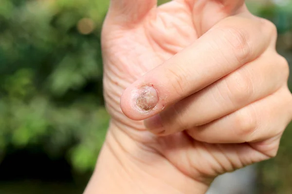 Μόλυνση μυκήτων στο χέρι με νύχια, δάχτυλο με ονυχομυκητίαση — Φωτογραφία Αρχείου