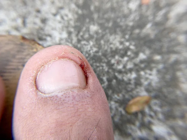 Damaged Toenail Close Shot — Stock Photo, Image