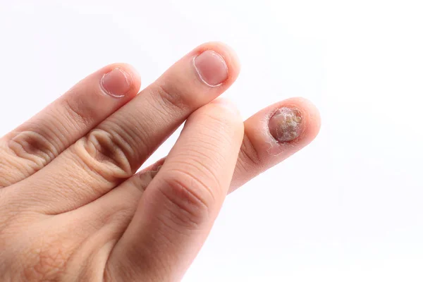 Грибковая инфекция на ногтях кисть, палец с онихомикозом, грибковая инфекция на ногтях handisolated на белом фоне . — стоковое фото