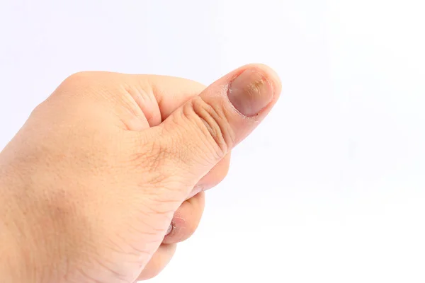 Çivi el, parmak Onikomikoz ile beyaz zemin üzerine çivi handisolated üzerinde mantar enfeksiyonu mantar enfeksiyonu.