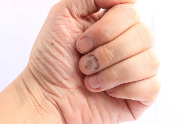 Грибковая Инфекция Ногтях Кисть Палец Онихомикозом Грибковая Инфекция Ногтях Handisolated — стоковое фото
