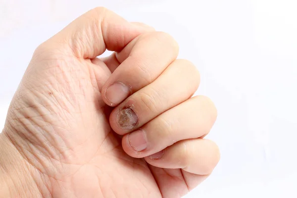 Fungus Infection on Nails Hand, Finger with onychomycosis, Fungal infection on nails handisolated on white background.