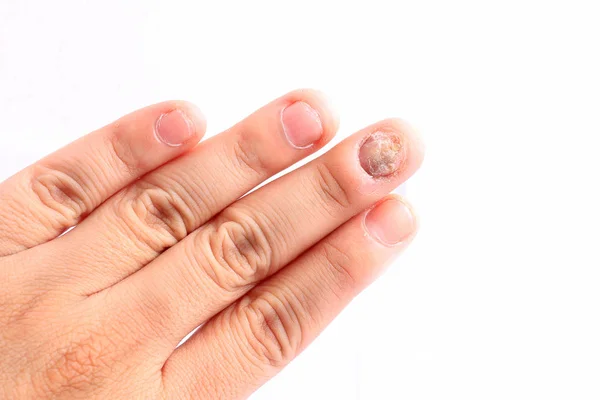 Fungus Infection Nails Hand Finger Onychomycosis Fungal Infection Nails Handisolated — Stock Photo, Image