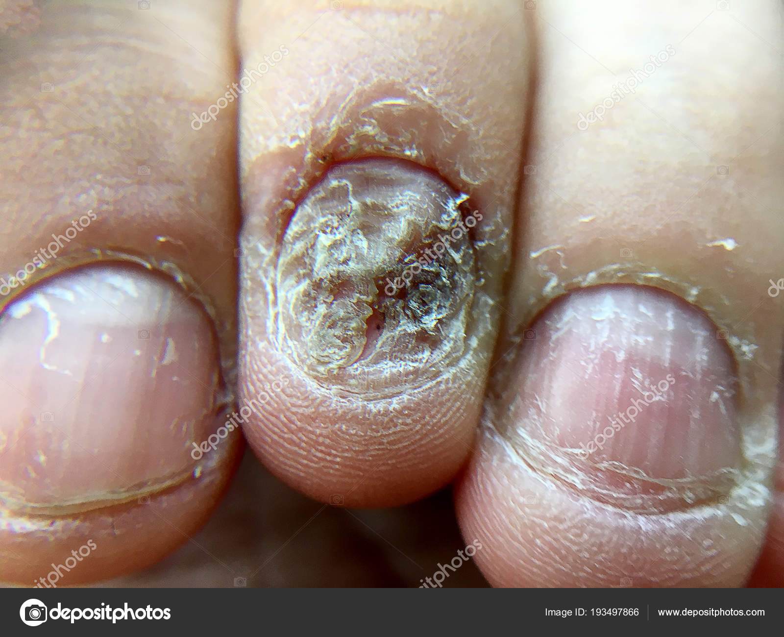How to Cure Fingernail Fungus Fast at Home: Effective Home Remedies and Tips