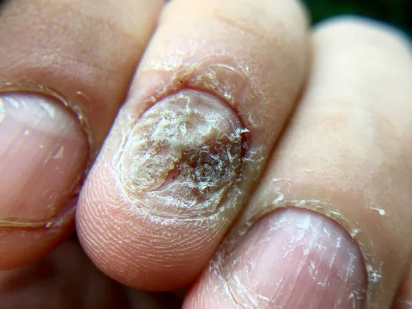 Big close up of fungus Infection on Nails Hand, Finger with onychomycosis, Fungal infection on nails.