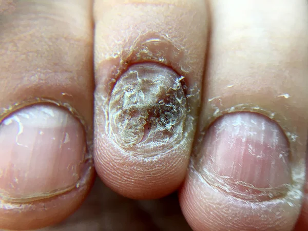 Big Close Fungus Infection Nails Hand Finger Onychomycosis Fungal Infection — Stock Photo, Image