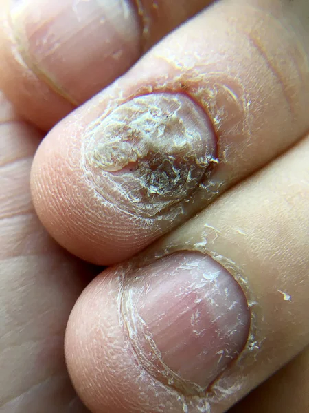 Big close up of fungus Infection on Nails Hand, Finger with onychomycosis, Fungal infection on nails.
