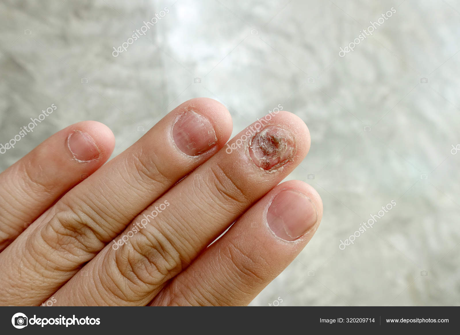 először finger nail gomba)