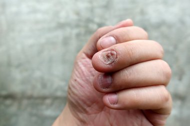 Mantar tırnak enfeksiyonu kapatın. Mantar enfeksiyonu çivi yandan, parmak Onikomikoz, gri beton duvar arka plan üzerinde insan eli zarar ile. Hastalık ve semptom kavramı.