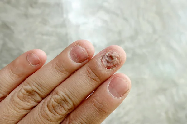 Закрыть Грибковую Инфекцию Ногтей Грибковая Инфекция Ладони Ногтей Палец Онихомикозом — стоковое фото