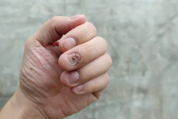 Fungal nail infection and damage on human hand. Finger with onychomycosis