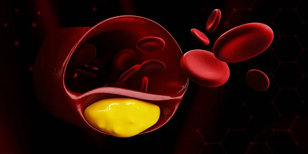 3d Illustration of human cardiovascular system with blood cells with plaque buildup of cholesterol symbol of vascular illness. — Stock Photo, Image