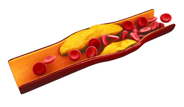 3D illustration av blodkroppar med plack byggs upp av kolesterol isolerade vit — Stockfoto