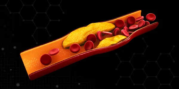 3D απεικόνιση των κυττάρων του αίματος με συσσώρευση πλάκας χοληστερόλης απομονωμένη μαύρο — Φωτογραφία Αρχείου
