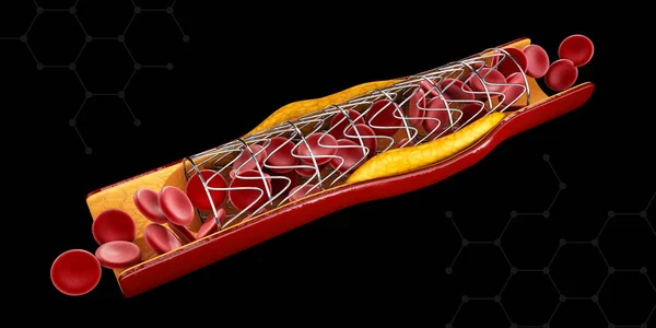 Stent implant kavramı bir kalp hastalığı tedavi olarak. 3D çizim.
