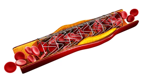 Conceito de implante de stent como tratamento de doenças cardíacas. Ilustração 3D. branco isolado — Fotografia de Stock