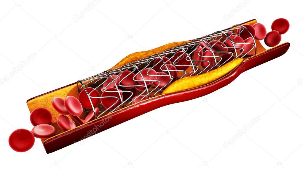 Stent implant concept as a heart disease treatment. 3D illustration. isolated white