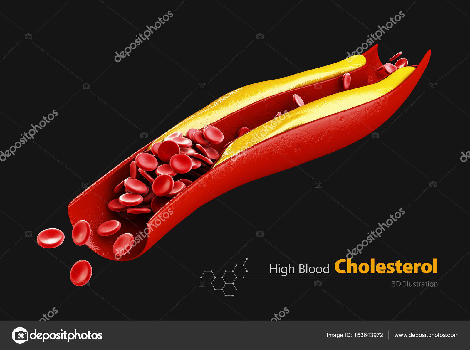 Cholesterol plaque in artery, 3d illustration. isolated black — Stock Photo  © tussiksmail.gmail.com #153643972, image size:1600x1192