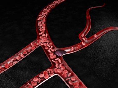 Blood clot risk and thrombosis medical 3d illustration clipart