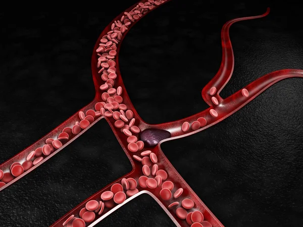 Vérrög kockázat és a trombózis orvosi 3D-s illusztráció — Stock Fotó