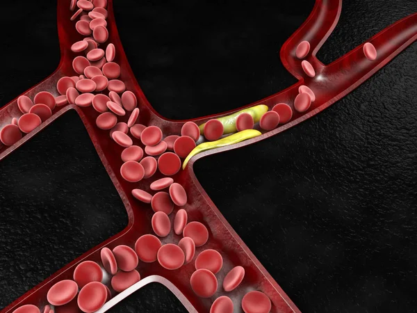 3d Ілюстрація клітин крові з накопиченням нальоту холестерину — стокове фото