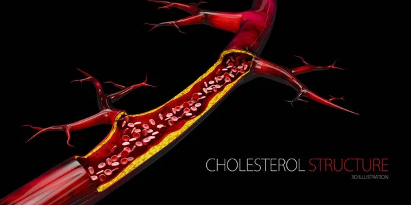 阻塞血管-动脉与胆固醇堆积现实3d 插图隔离背景 — 图库照片