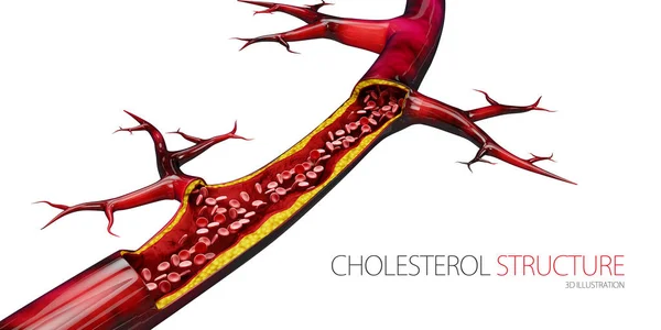 Verstopfte Blutgefäße - Arterie mit Cholesterinanreicherung realistische 3D-Illustration isoliert weiß — Stockfoto