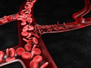 Anemi, orak hücre ve normal kırmızı kan hücresi, 3d çizim
