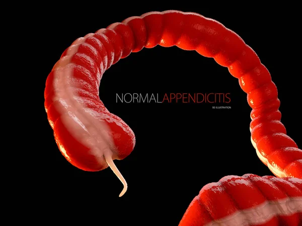 Ilustração 3D do conceito da apendicite, anatomia do intestino humano isolado preto — Fotografia de Stock