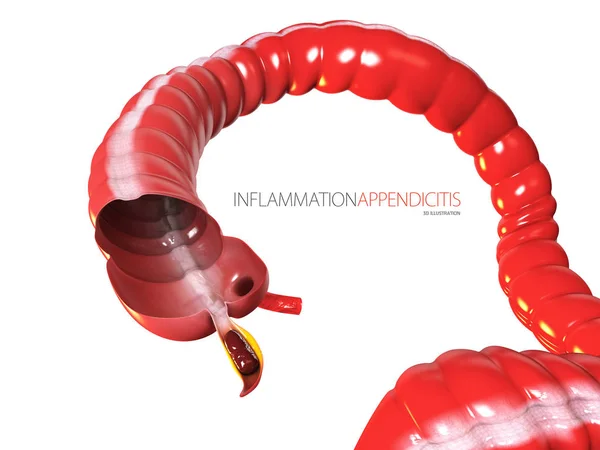 Conceito de apendicite, anatomia do intestino humano como uma ilustração 3D — Fotografia de Stock