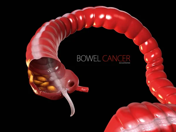 Câncer colorretal, fundo preto isolado 3d ilustração — Fotografia de Stock