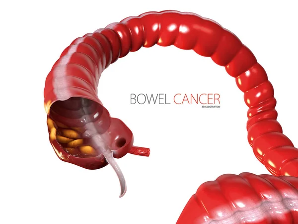 Ilustración 3d del cáncer colorrectal, fondo blanco aislado — Foto de Stock