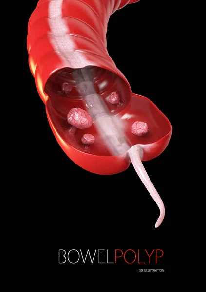 Pólipos de colon. 3d illustration- Pólipo en el intestino. negro aislado —  Fotos de Stock