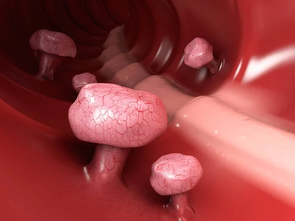 3D illustration av kolon polyper. Polyp i tarmen. isolerade vit — Stockfoto