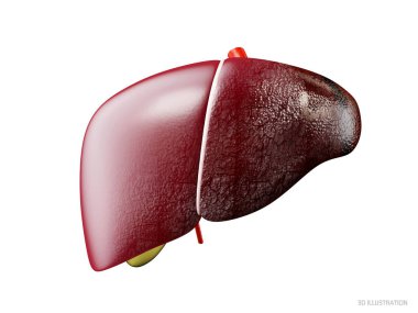 Gerçekçi 3d illüstrasyon insan sağlıklı ve hasta siroz karaciğer comparsion, beyaz izole