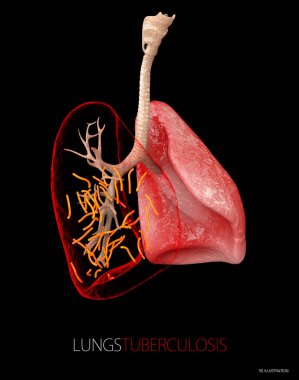 Bakteri Mycobacterium verem, tüberküloz, 3d çizim hastalığının