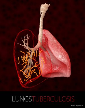 Bakteri Mycobacterium verem, tüberküloz, 3d çizim hastalığının