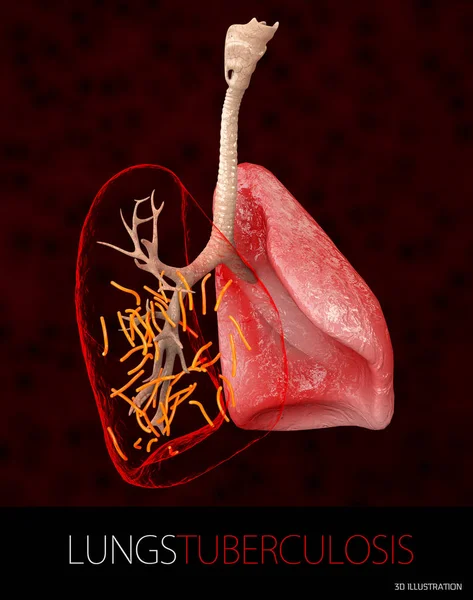 Bacterias Mycobacterium tuberculosis, el agente causal de la tuberculosis, ilustración 3D — Foto de Stock