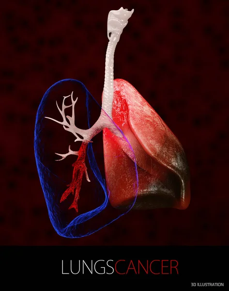 3d Ilustración de cáncer de pulmón, derrame pleural aislado negro — Foto de Stock
