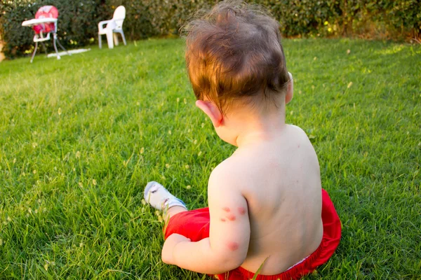 Neugeborene mit mehreren Mückenstichen. Allergie gegen Insektenstiche — Stockfoto