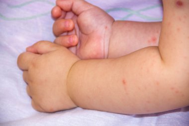Dermatit döküntü problemini bebekle. Yiyecek Alerji acı Anti. Yakın çekim cilt yanaklarda Atopik belirti. kavramı