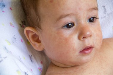 Dermatit döküntü problemini bebekle. Yiyecek Alerji acı Anti. Yakın çekim cilt yanaklarda Atopik belirti. kavramı