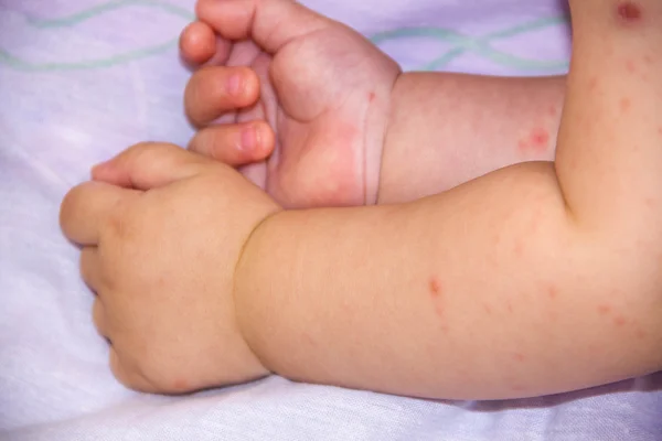 Bebê com problema de dermatite de erupção cutânea. Alergia que sofre de alergias alimentares. Sintoma atópico de perto nas bochechas da pele. conceito — Fotografia de Stock