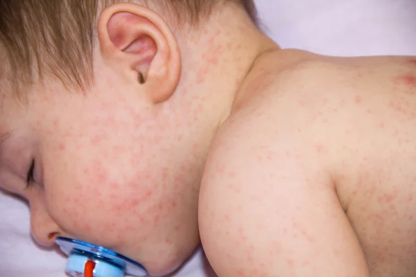 Ребенок с проблемой дерматита сыпи. Аллергия на продукты питания. Крупный атопический симптом на щеках кожи. концепция — стоковое фото