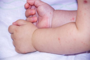 Çocuk egzama tarafından kaplı küçük bir el. Anti Bebek Cilt dermatit maması. Dermatit belirti sorun döküntü. Yenidoğan uyku yüzü. Atopik cilt yanaklarda acı. kavram çocuk sağlığı