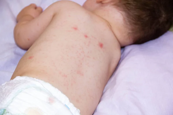 Alergi kulit bayi dermatitis makanan. gejala dermatitis anak ruam masalah. bayi yang baru lahir. menderita gejala atopik pada pipi kulit. konsep kesehatan anak — Stok Foto